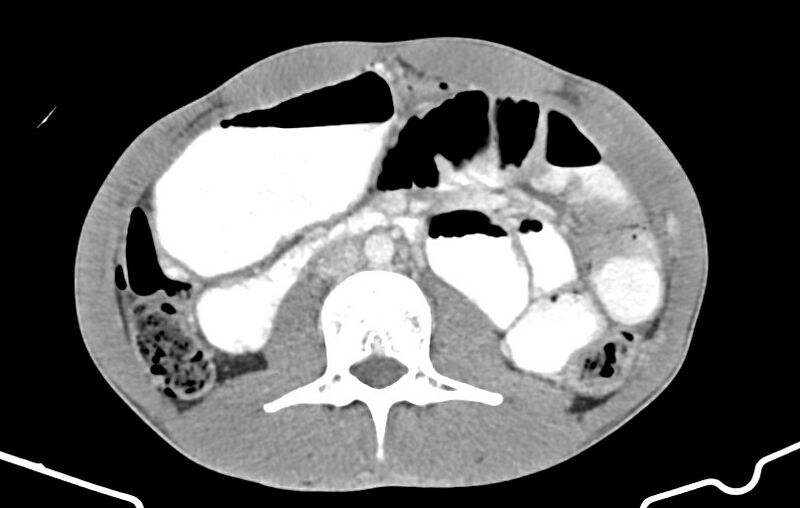 File:Blunt injury to the small bowel (Radiopaedia 74953-85987 A 81).jpg