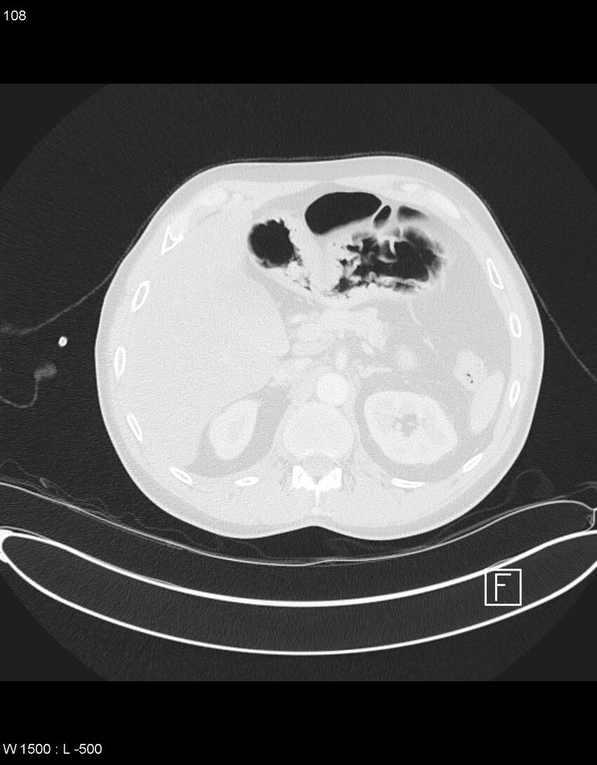 Boerhaave syndrome with tension pneumothorax (Radiopaedia 56794-63605 Axial lung window 53).jpg