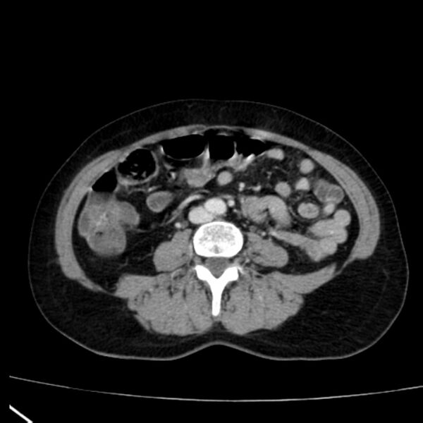 File:Bosniak renal cyst - type I (Radiopaedia 27479-27675 C 54).jpg