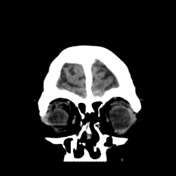 File:Brain cortical laminar necrosis (Radiopaedia 25822-25971 C 7).jpg