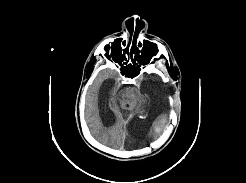 Brain injury by firearm projectile (Radiopaedia 82068-96088 A 110).jpg