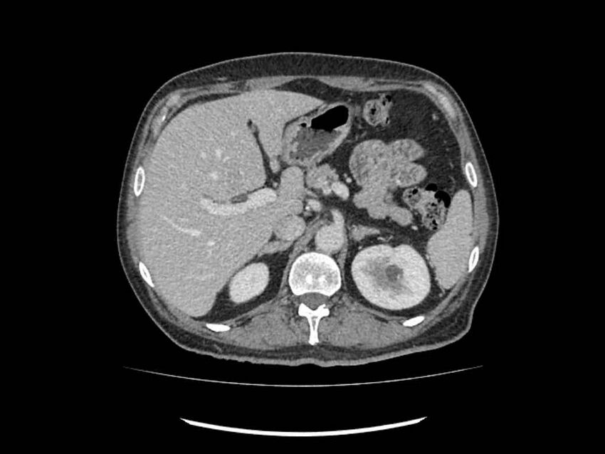Brain metastases from renal cell carcinoma (Radiopaedia 42222-45328 B 36).jpg