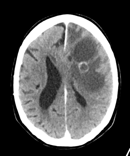 File:Brain metastasis (lung cancer) (Radiopaedia 48289-53177 Axial C+ 20).png
