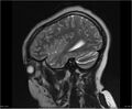 Brainstem glioma (Radiopaedia 21819-21775 Sagittal T2 3).jpg
