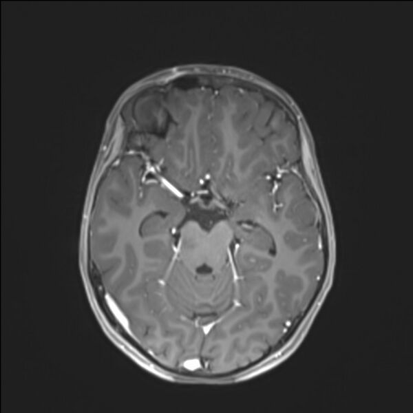 File:Brainstem glioma (Radiopaedia 70548-80674 Axial T1 C+ 67).jpg