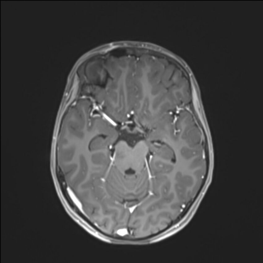 Brainstem glioma (Radiopaedia 70548-80674 Axial T1 C+ 67).jpg