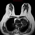 Breast carcinoma (multicentric multifocal in mammary Paget disease) (Radiopaedia 50966-56512 Axial T2 10).jpg