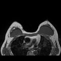 Breast implants - MRI (Radiopaedia 26864-27035 Axial T1 35).jpg