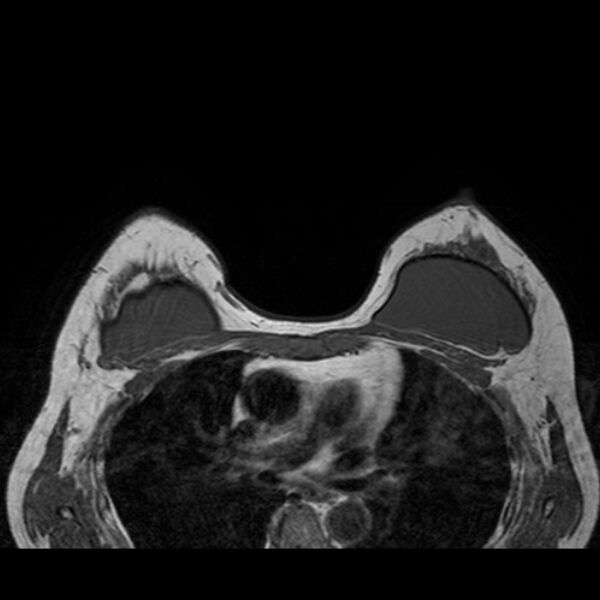 File:Breast implants - MRI (Radiopaedia 26864-27035 Axial T1 35).jpg