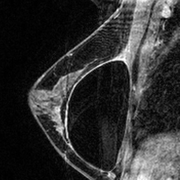 File:Breast implants - MRI (Radiopaedia 26864-27035 Sagittal T2 106).jpg