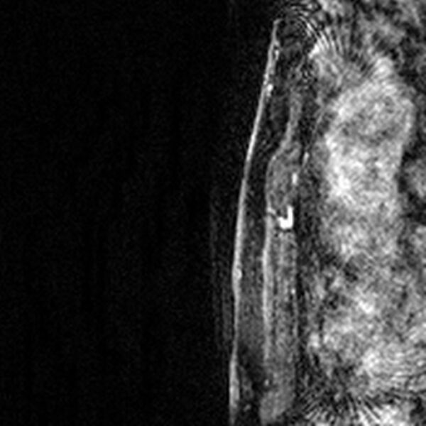 File:Breast implants - MRI (Radiopaedia 26864-27035 Sagittal T2 69).jpg