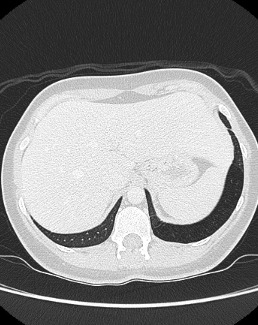 Bronchial atresia (Radiopaedia 50007-55297 Axial lung window 103).jpg