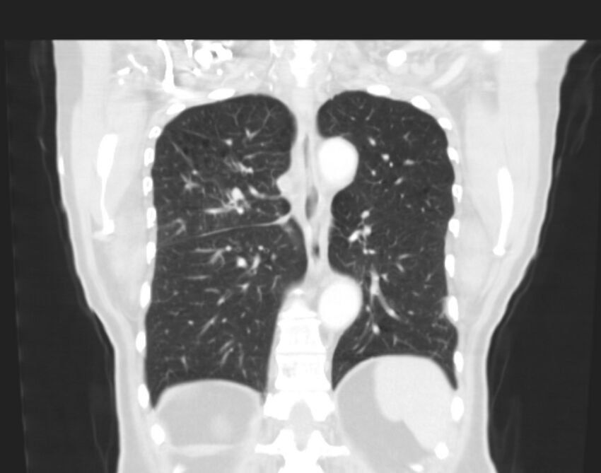 Bronchogenic carcinoma with lymphangitic spread (Radiopaedia 29002-29357 Coronal lung window 49).jpg