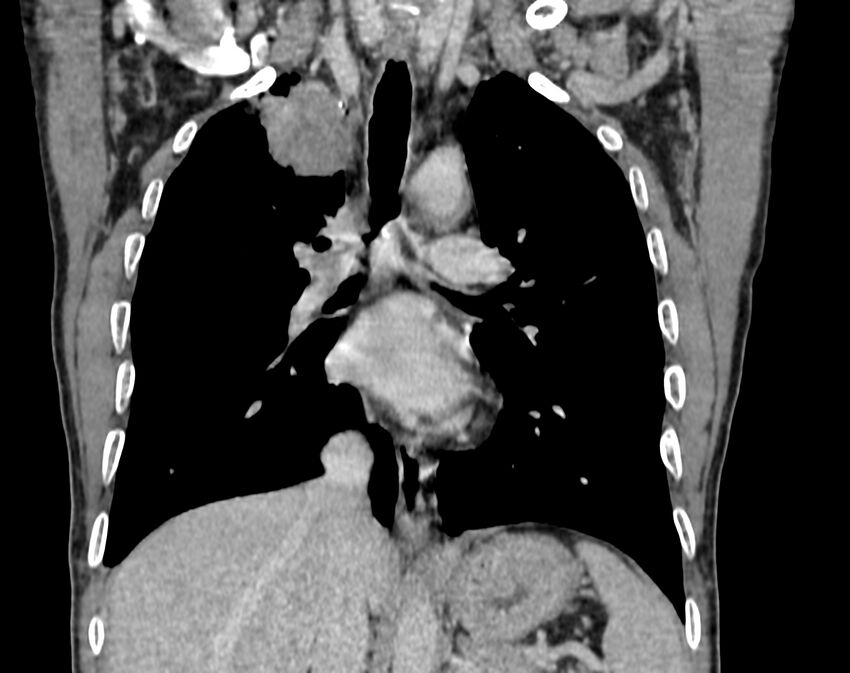 Bronchogenic carcinoma with superior vena cava syndrome (Radiopaedia 36497-38054 Coronal C+ delayed 47).jpg