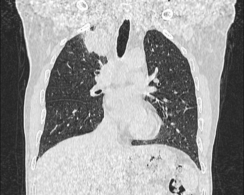 Bronchogenic carcinoma with superior vena cava syndrome (Radiopaedia 36497-38054 Coronal lung window 31).jpg