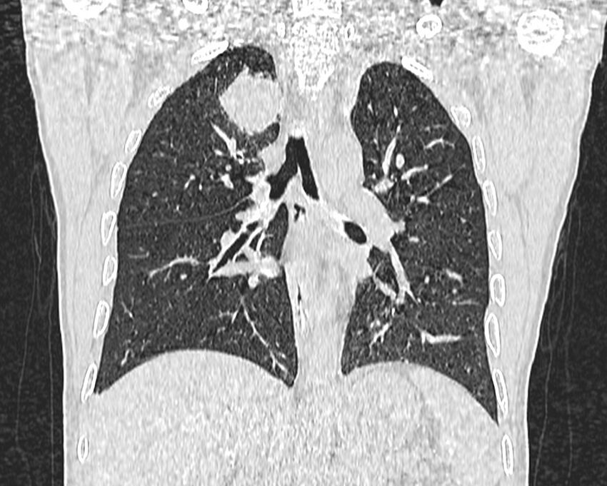 Bronchogenic carcinoma with superior vena cava syndrome (Radiopaedia 36497-38054 Coronal lung window 54).jpg