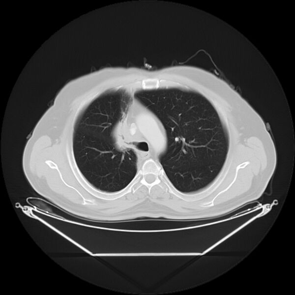 File:Bronchogenic carcinoma with upper lobe collapse (Radiopaedia 29297-29726 Axial lung window 12).jpg