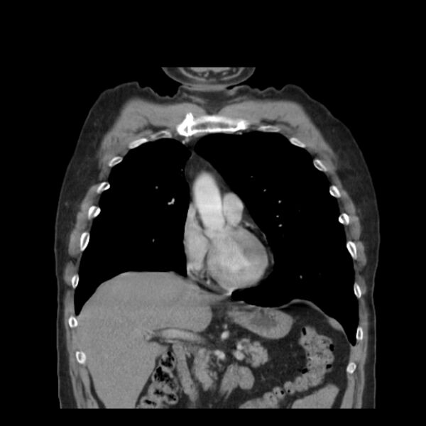 File:Bronchogenic carcinoma with upper lobe collapse (Radiopaedia 29297-29726 D 23).jpg
