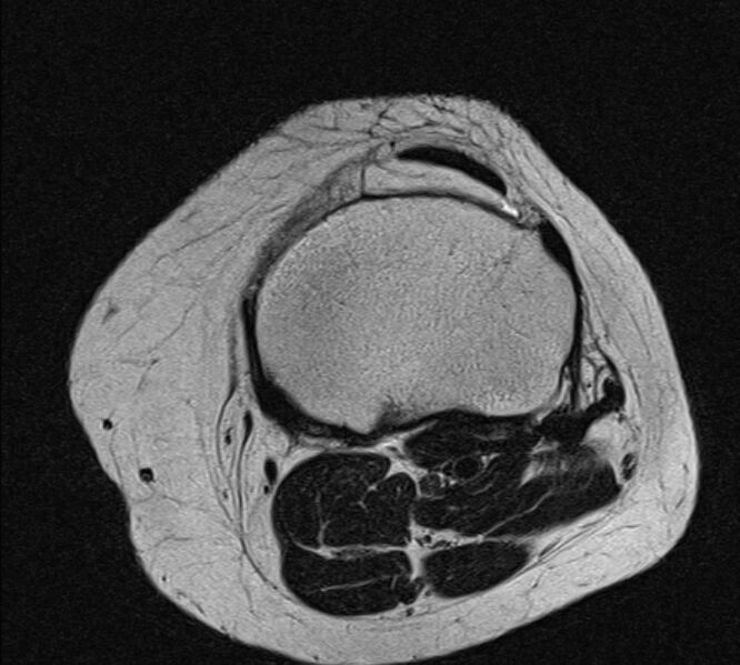 File:Bucket handle tear - medial meniscus (Radiopaedia 79028-91942 Axial T2 6).jpg