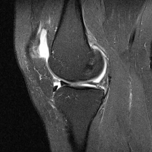 File:Bucket handle tear - medial meniscus (Radiopaedia 79028-91942 Sagittal PD fat sat 16).jpg