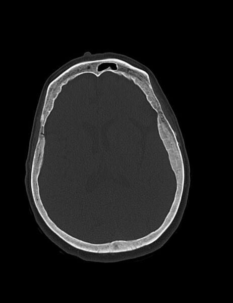 File:Burnt-out meningioma (Radiopaedia 51557-57337 Axial bone window 28).jpg