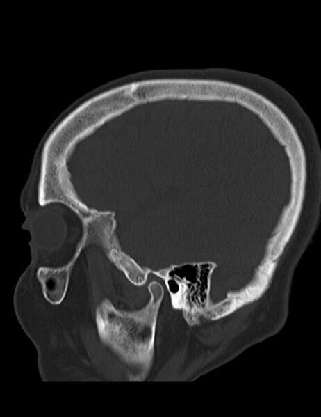 File:Burnt-out meningioma (Radiopaedia 51557-57337 Sagittal bone window 36).jpg