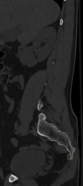 File:Calcaneal fractures with associated L2 burst fracture (Radiopaedia 71671-82493 Sagittal bone window 71).jpg