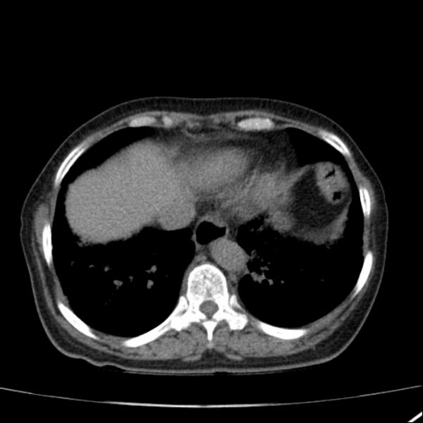 File:Calcified hepatic hydatid cyst (Radiopaedia 26872-27046 Axial non-contrast 12).jpg