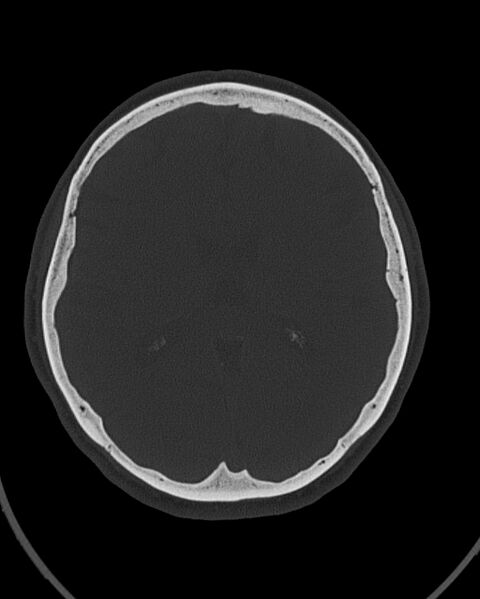 File:Calcified meningioma (Radiopaedia 74361-85243 Axial bone window 24).jpg