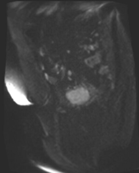 File:Cancer cervix - stage IIb (Radiopaedia 75411-86615 Sagittal DWI 66).jpg