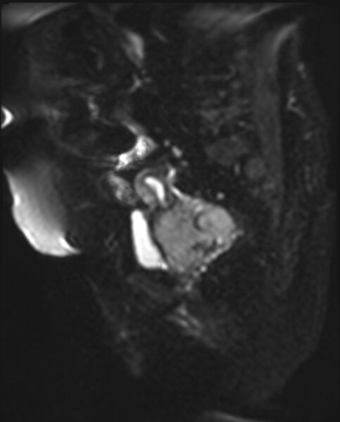 File:Cancer cervix - stage IIb (Radiopaedia 75411-86615 Sagittal DWI 8).jpg