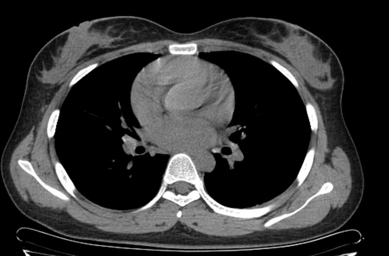 File:Cannonball metastases - uterine choriocarcinoma (Radiopaedia 70137-80173 Axial non-contrast 58).jpg