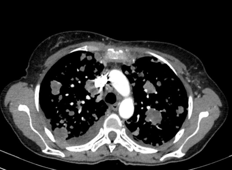 File:Cannonball metastases from breast cancer (Radiopaedia 91024-108569 A 40).jpg
