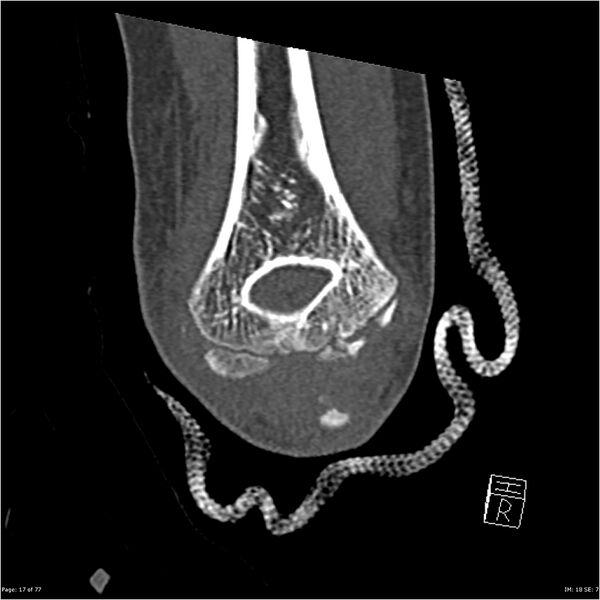 File:Capitellum fracture (Radiopaedia 23352-23426 Coronal bone window 17).jpg