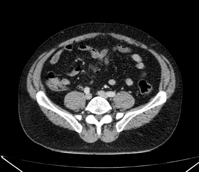 File:Carcinoid tumor with hepatic metastases (Radiopaedia 22651-22670 C 60).jpg