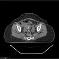 Carcinoma cervix- brachytherapy applicator (Radiopaedia 33135-34173 Axial non-contrast 25).jpg