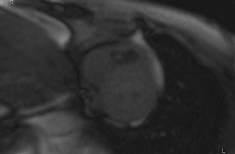 File:Cardiac hemangioma (Radiopaedia 31709-32631 Short axis 83).jpg