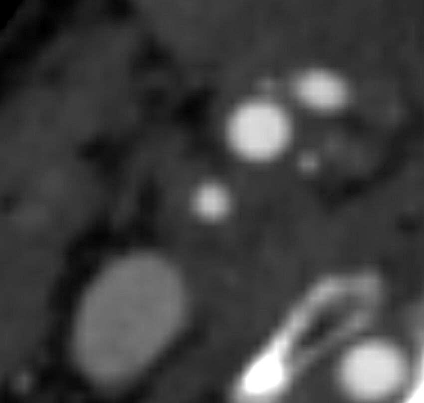 Carotid near-occlusion (Radiopaedia 85304-100887 M 84).jpg