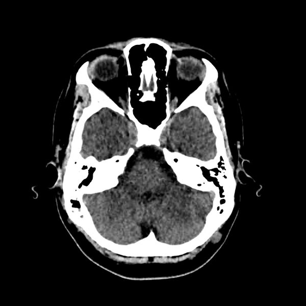 File:Central nervous system Langerhans cell histiocytosis (Radiopaedia 65728-74878 Axial non-contrast 15).jpg