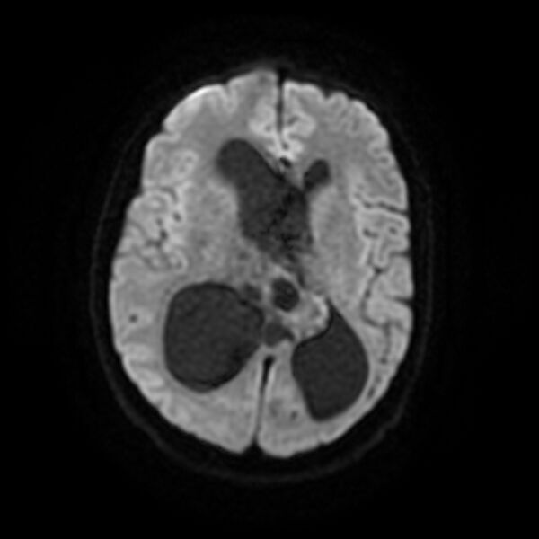 File:Central neurocytoma (Radiopaedia 67618-77021 Axial DWI 12).jpg
