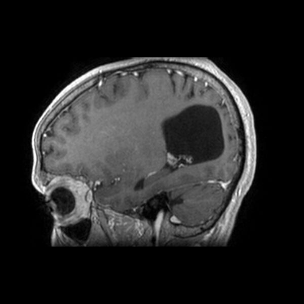 File:Central neurocytoma (Radiopaedia 67618-77021 Sagittal T1 C+ 21).jpg