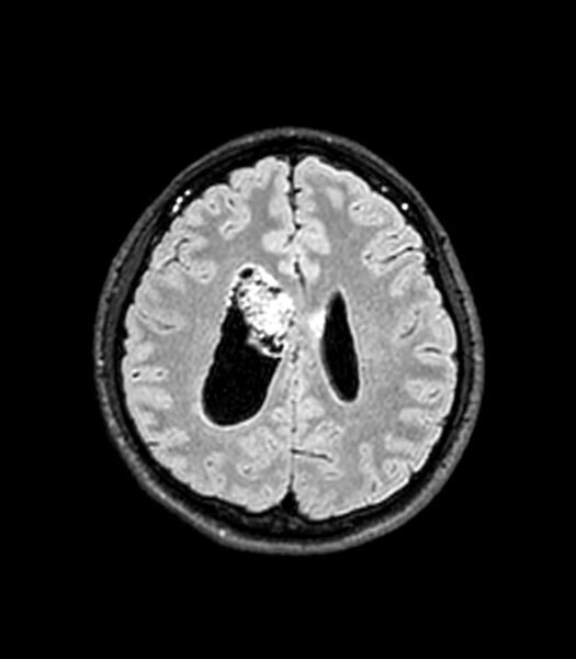 File:Central neurocytoma (Radiopaedia 79320-92380 Axial FLAIR 110).jpg