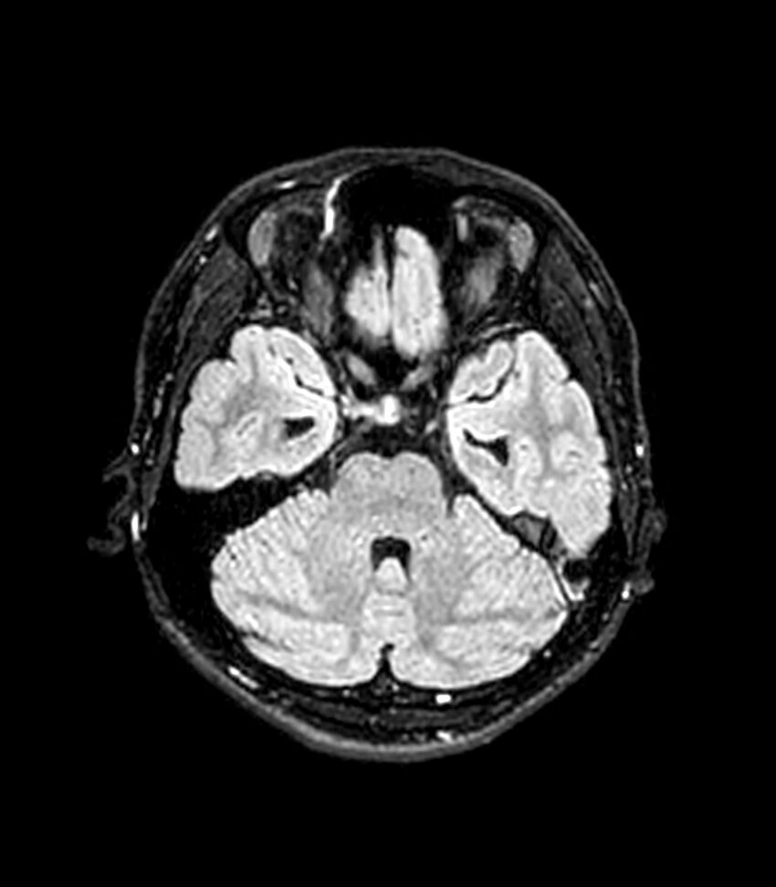 Central neurocytoma (Radiopaedia 79320-92380 Axial FLAIR 213).jpg