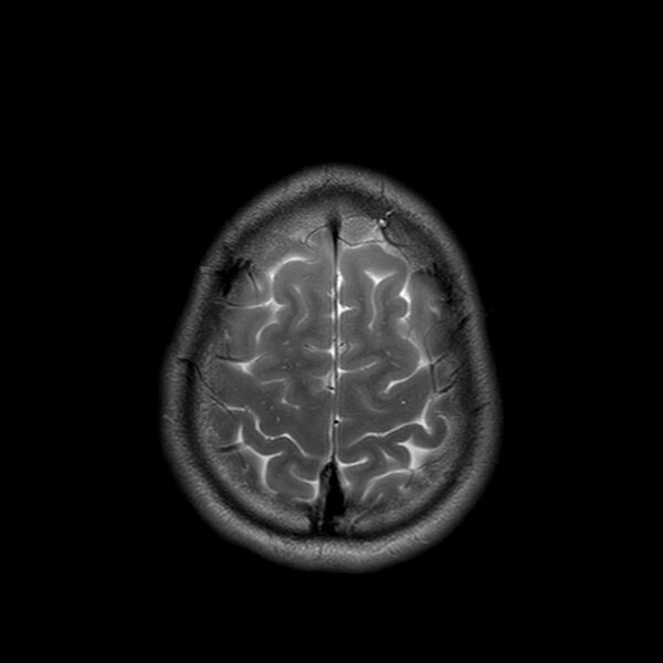 File:Central neurocytoma (Radiopaedia 79320-92380 Axial T2 24).jpg