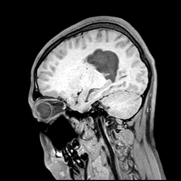 File:Central neurocytoma (Radiopaedia 79320-92380 Sagittal T1 175).jpg
