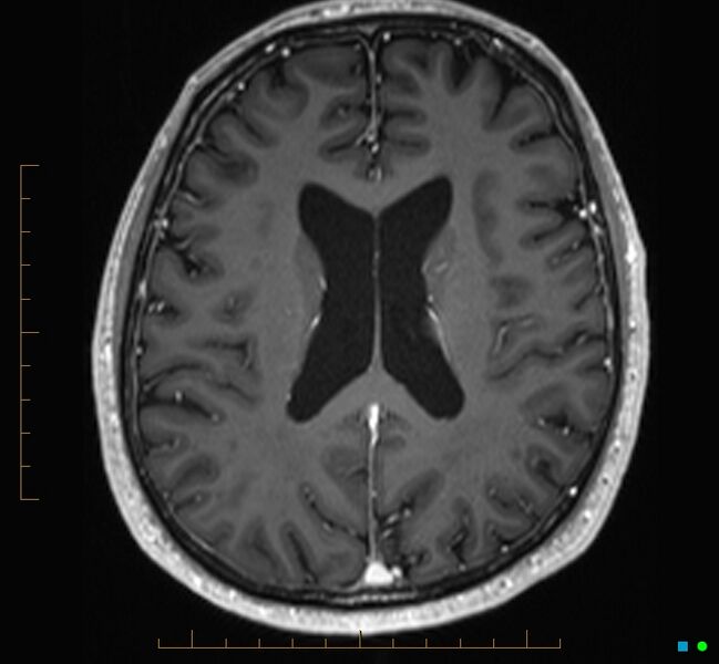 File:Cerebellar gangliocytoma (Radiopaedia 65377-74422 Axial T1 C+ 82).jpg