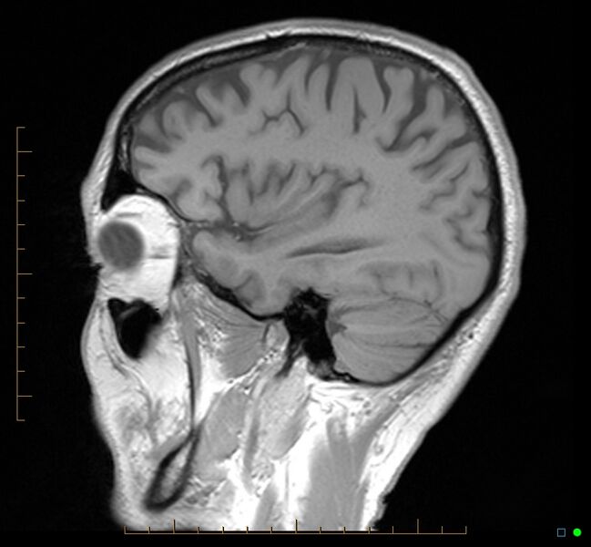 File:Cerebellar gangliocytoma (Radiopaedia 65377-74422 Sagittal T1 33).jpg
