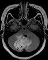 Cerebellar hemangioblastoma (Radiopaedia 10779-11234 Axial FLAIR 1).JPG