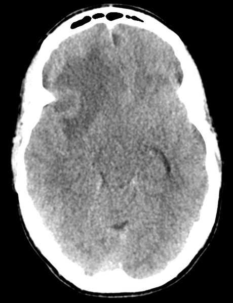 File:Cerebral abscess (Radiopaedia 60342-68008 Axial non-contrast 22).png