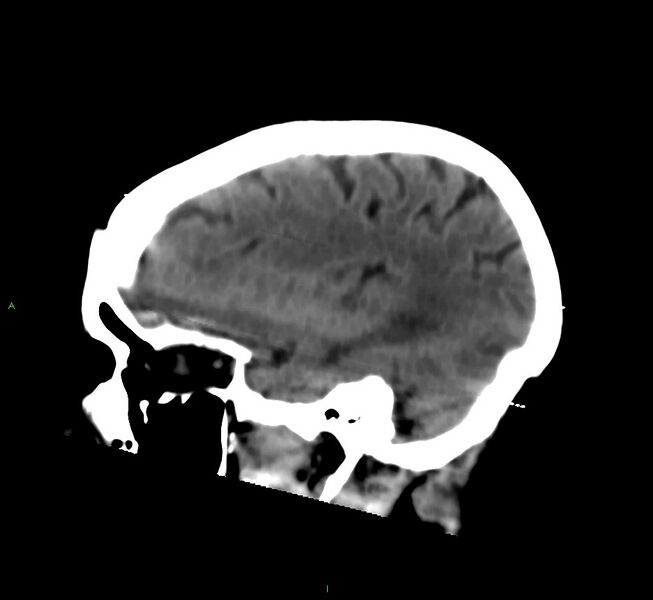 File:Cerebral amyloid angiopathy-associated lobar intracerebral hemorrhage (Radiopaedia 58377-65514 B 37).jpg